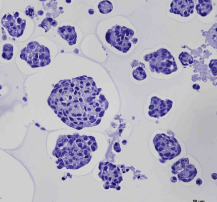 Gastric cancer organoid – H&E stain