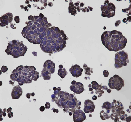 Gastric cancer organoid – IHC (Claudin 18.2)