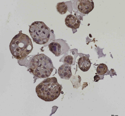 Lung cancer organoid – IHC (PD-L1)