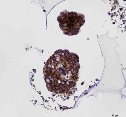 Lung cancer organoid – IHC (EPCAM)